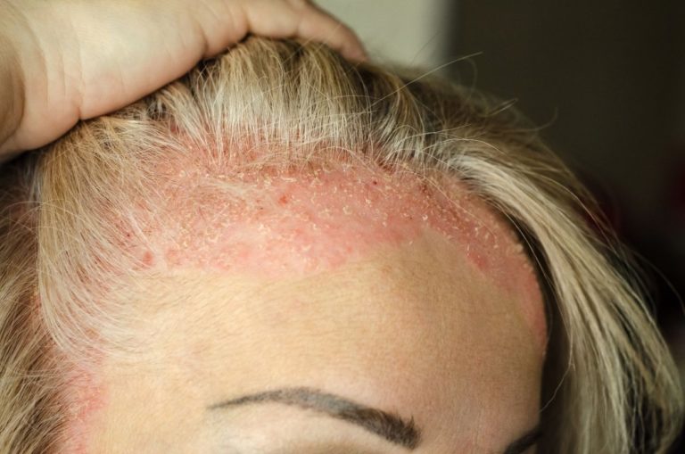 Stress et psoriasis du cuir chevelu : quelle solution